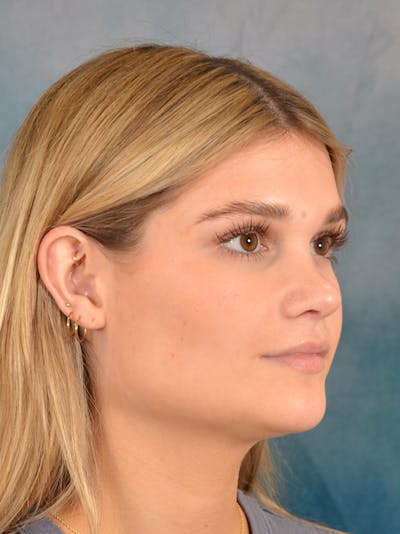 Rhinoplasty Before & After Gallery - Patient 181417 - Image 8