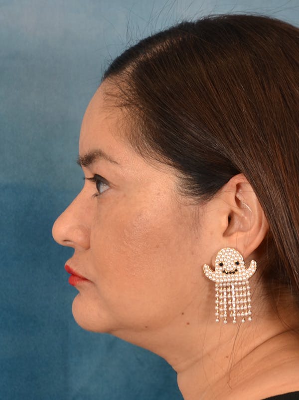 Rhinoplasty Before & After Gallery - Patient 355329 - Image 1