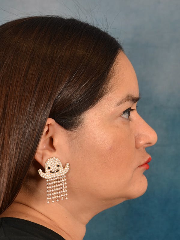 Rhinoplasty Before & After Gallery - Patient 355329 - Image 9