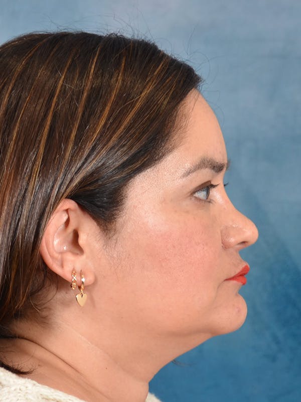 Rhinoplasty Before & After Gallery - Patient 355329 - Image 10