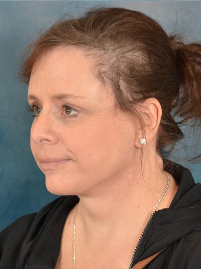 Deep Plane Facelift Before & After Gallery - Patient 101962 - Image 2