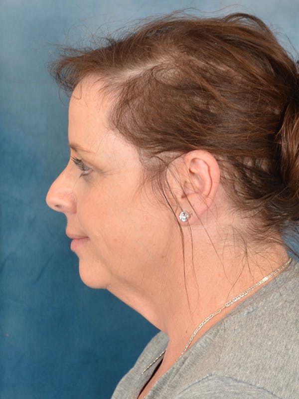 Deep Plane Facelift Before & After Gallery - Patient 101962 - Image 3