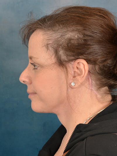 Deep Plane Facelift Before & After Gallery - Patient 101962 - Image 4