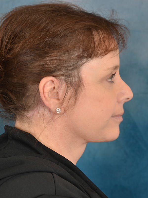 Deep Plane Facelift Before & After Gallery - Patient 101962 - Image 10