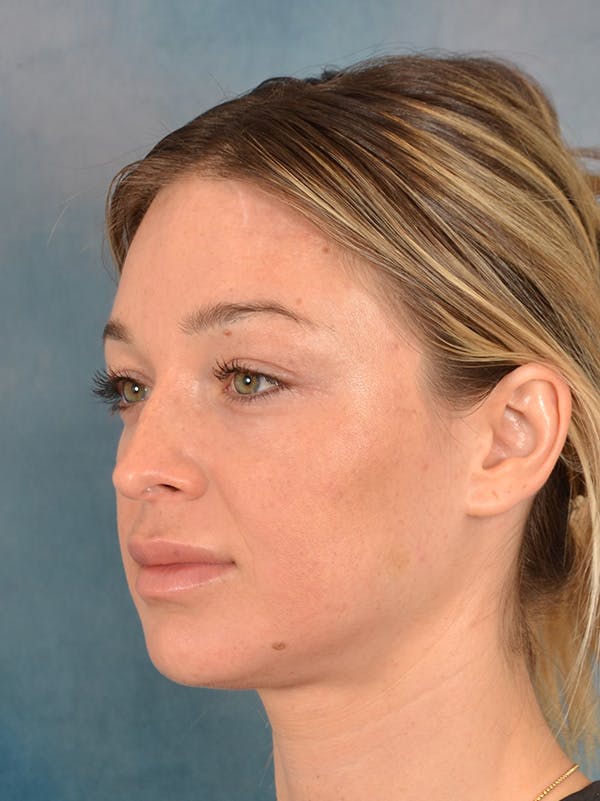 Rhinoplasty Before & After Gallery - Patient 318007 - Image 3