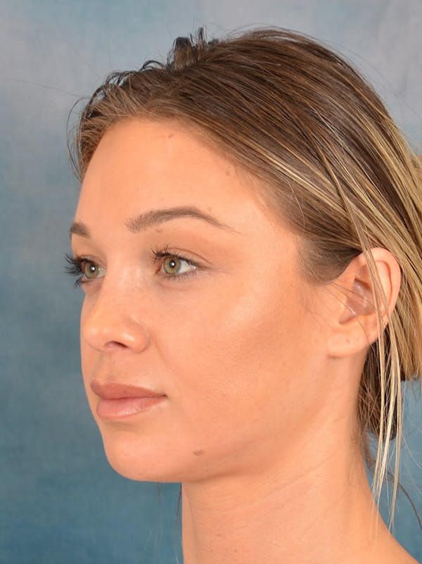 Rhinoplasty Before & After Gallery - Patient 318007 - Image 4