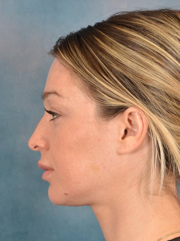Rhinoplasty Before & After Gallery - Patient 318007 - Image 1