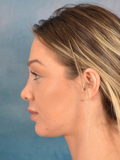 Rhinoplasty Before & After Gallery - Patient 318007 - Image 2