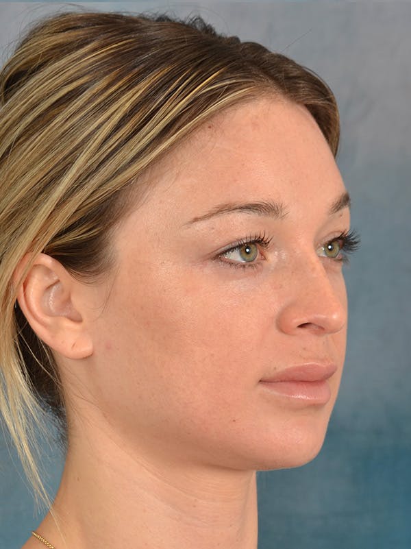Rhinoplasty Before & After Gallery - Patient 318007 - Image 7