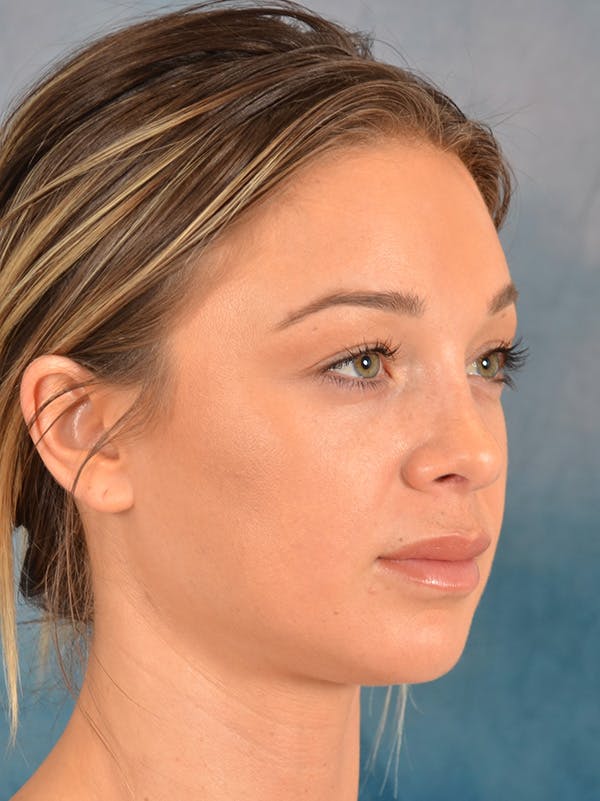Rhinoplasty Before & After Gallery - Patient 318007 - Image 8