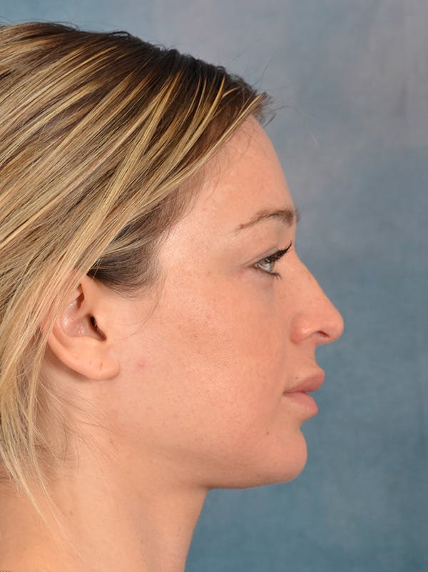 Rhinoplasty Before & After Gallery - Patient 318007 - Image 9