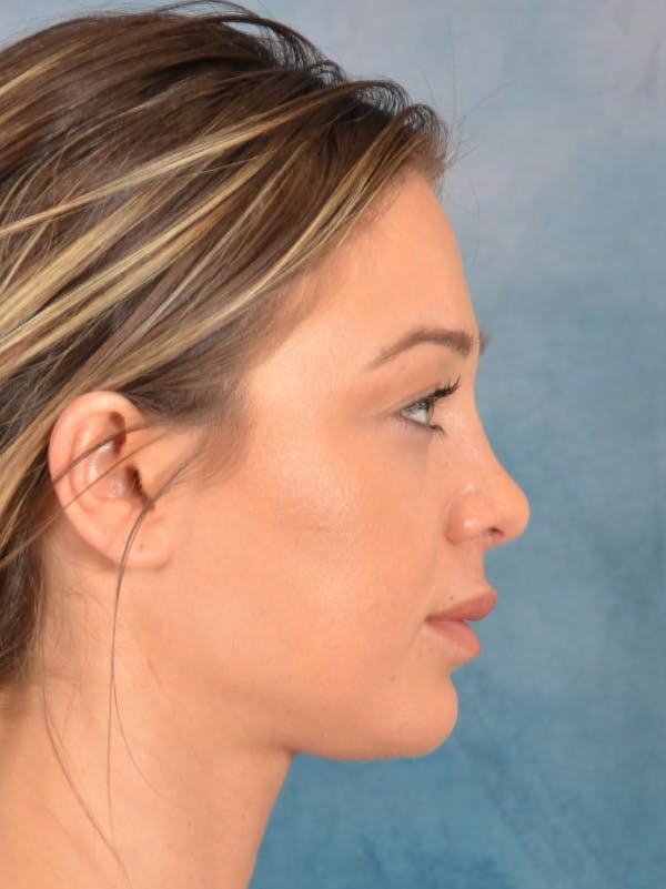 Rhinoplasty Before & After Gallery - Patient 318007 - Image 10