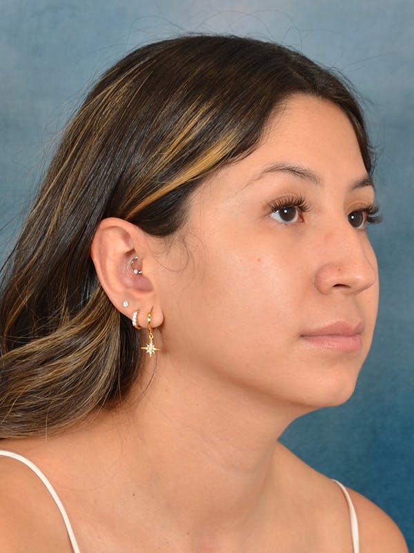 Rhinoplasty Before & After Gallery - Patient 285575 - Image 7