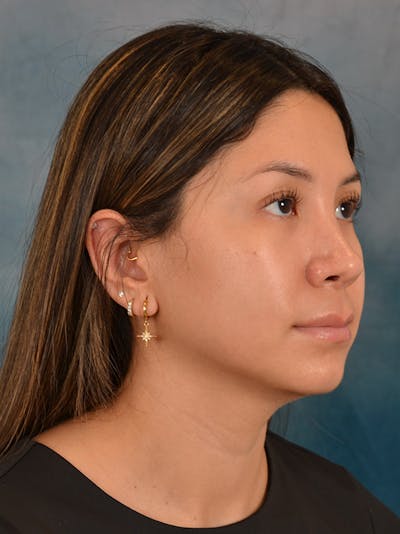 Rhinoplasty Before & After Gallery - Patient 285575 - Image 8