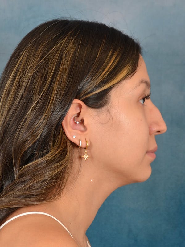 Rhinoplasty Before & After Gallery - Patient 285575 - Image 9