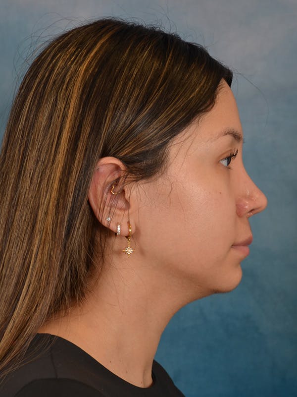 Rhinoplasty Before & After Gallery - Patient 285575 - Image 10