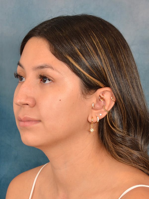 Rhinoplasty Before & After Gallery - Patient 285575 - Image 3