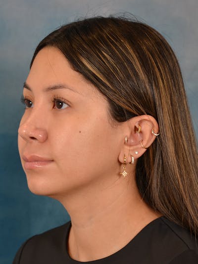 Rhinoplasty Before & After Gallery - Patient 285575 - Image 4