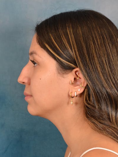 Rhinoplasty Before & After Gallery - Patient 285575 - Image 1