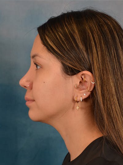 Rhinoplasty Before & After Gallery - Patient 285575 - Image 2