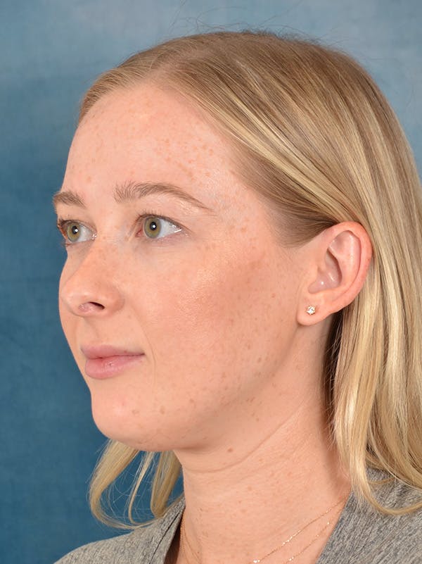 Rhinoplasty Before & After Gallery - Patient 245647 - Image 3