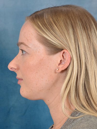 Rhinoplasty Before & After Gallery - Patient 245647 - Image 1