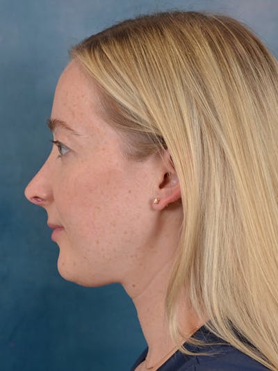 Rhinoplasty Before & After Gallery - Patient 245647 - Image 2