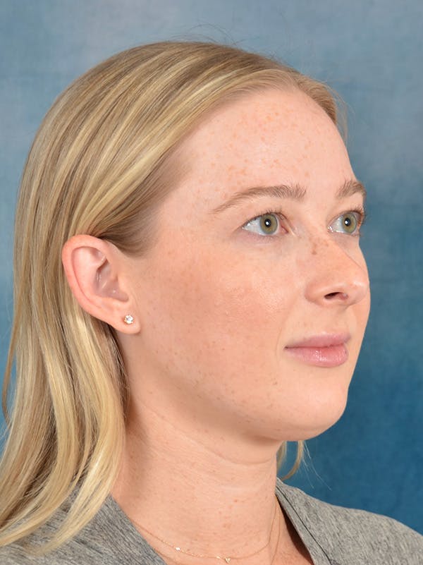 Rhinoplasty Before & After Gallery - Patient 245647 - Image 7