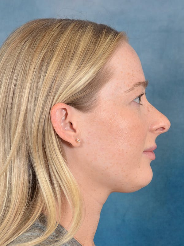 Rhinoplasty Before & After Gallery - Patient 245647 - Image 9