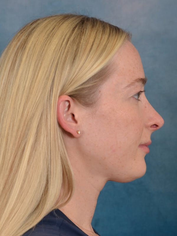 Rhinoplasty Before & After Gallery - Patient 245647 - Image 10