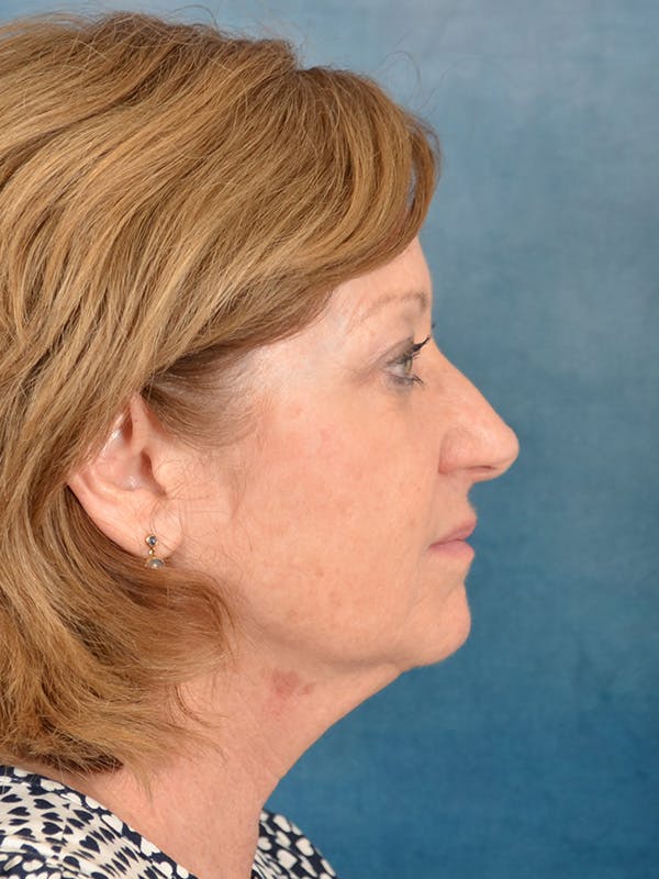 Deep Plane Facelift Before & After Gallery - Patient 207474 - Image 5