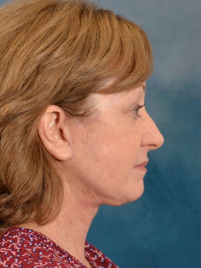 Deep Plane Facelift Before & After Gallery - Patient 207474 - Image 6