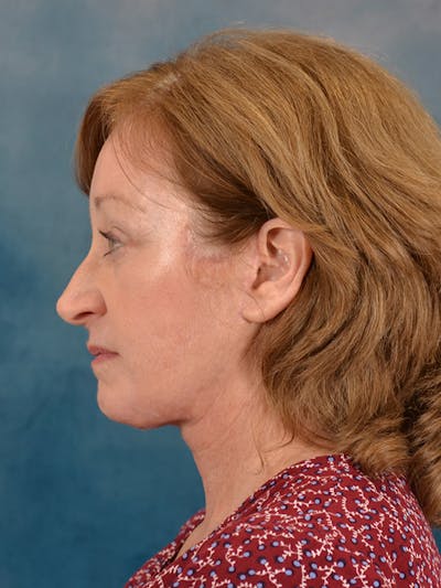 Deep Plane Facelift Before & After Gallery - Patient 207474 - Image 8