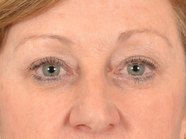 Eyelid Lift Before & After Gallery - Patient 268993 - Image 1