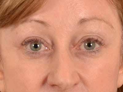 Eyelid Lift Before & After Gallery - Patient 268993 - Image 2
