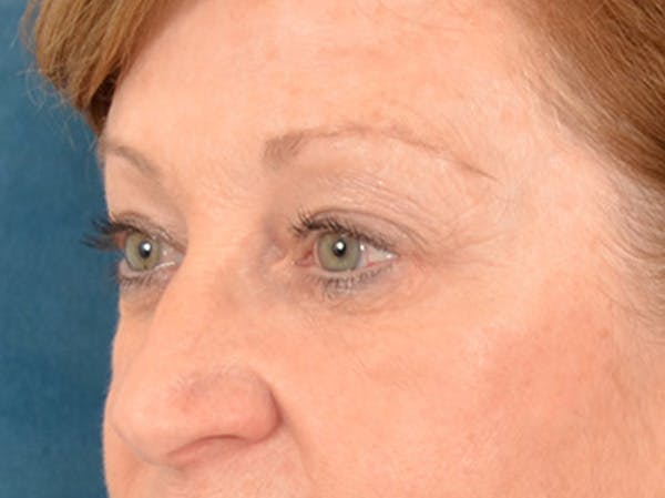 Eyelid Lift Before & After Gallery - Patient 268993 - Image 3