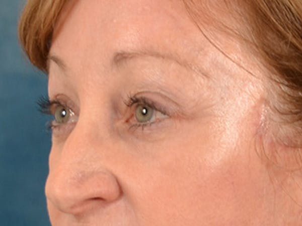 Eyelid Lift Before & After Gallery - Patient 268993 - Image 4