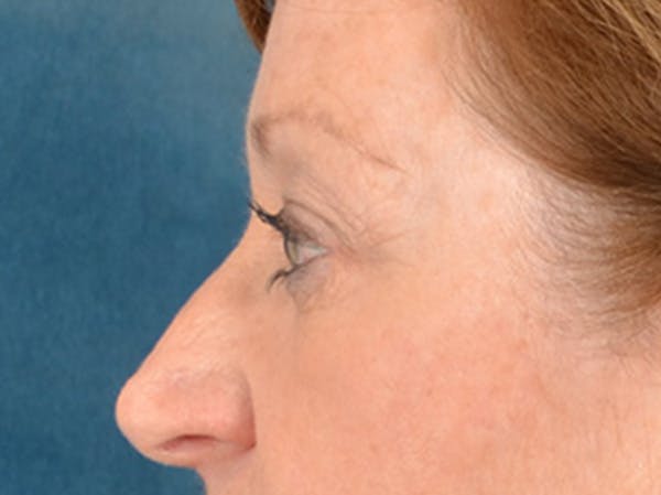 Eyelid Lift Before & After Gallery - Patient 268993 - Image 5