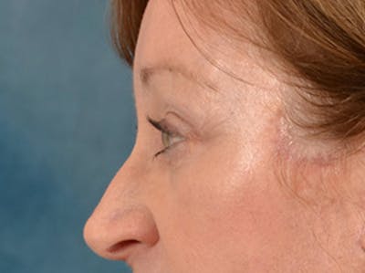 Eyelid Lift Before & After Gallery - Patient 268993 - Image 6