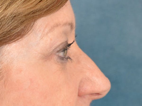 Eyelid Lift Before & After Gallery - Patient 268993 - Image 7