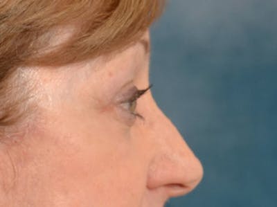 Eyelid Lift Before & After Gallery - Patient 268993 - Image 8