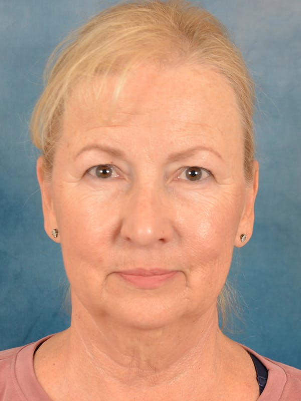 Deep Plane Facelift Before & After Gallery - Patient 307615 - Image 3