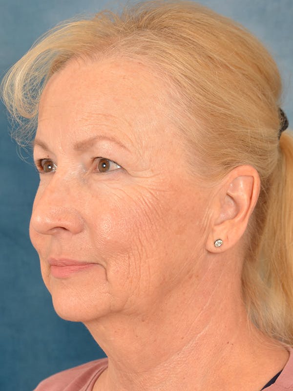 Laser Skin Resurfacing Before & After Gallery - Patient 158375 - Image 3