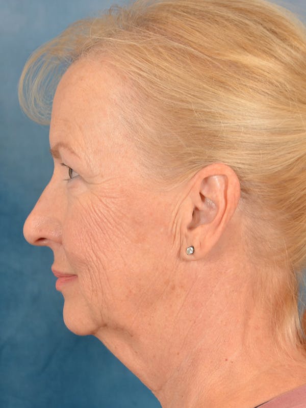 Laser Skin Resurfacing Before & After Gallery - Patient 158375 - Image 5