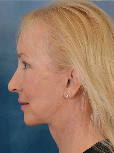 Laser Skin Resurfacing Before & After Gallery - Patient 158375 - Image 6
