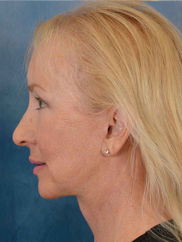 Deep Plane Facelift Before & After Gallery - Patient 307615 - Image 6