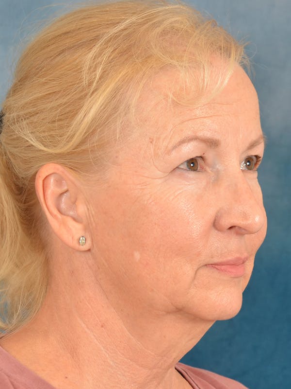 Deep Plane Facelift Before & After Gallery - Patient 307615 - Image 7