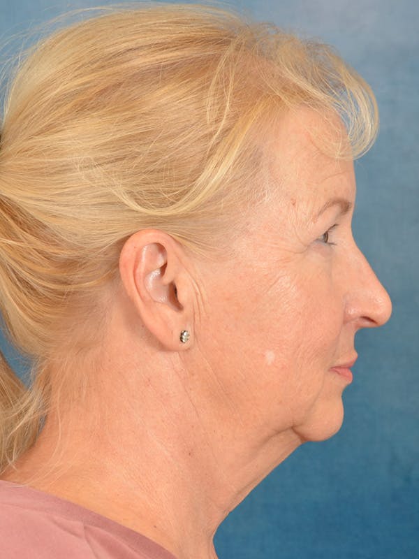 Laser Skin Resurfacing Before & After Gallery - Patient 158375 - Image 9