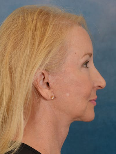 Deep Plane Facelift Before & After Gallery - Patient 307615 - Image 10