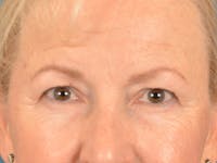 Brow Lift Before & After Gallery - Patient 102775 - Image 1